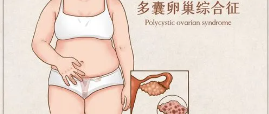 调整生活方式，多囊卵巢综合征患者也能轻松怀孕